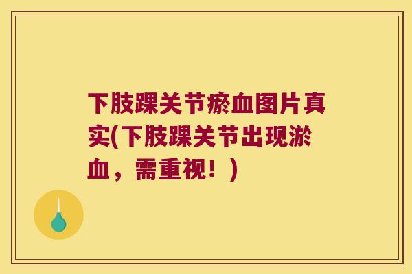 下肢踝关节瘀图片真实(下肢踝关节出现淤,需重视!) 下肢踝关节瘀图片真实(下肢踝关节出现淤,需重视!)