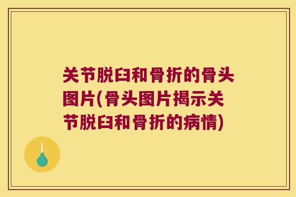 关节脱臼和的骨头图片(骨头图片揭示关节脱臼和的情) 关节脱臼和的骨头图片(骨头图片揭示关节脱臼和的情)