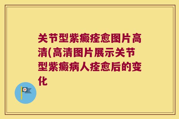 关节型紫癜痊愈图片高清(高清图片展示关节型紫癜人痊愈后的变化 关节型紫癜痊愈图片高清(高清图片展示关节型紫癜人痊愈后的变化