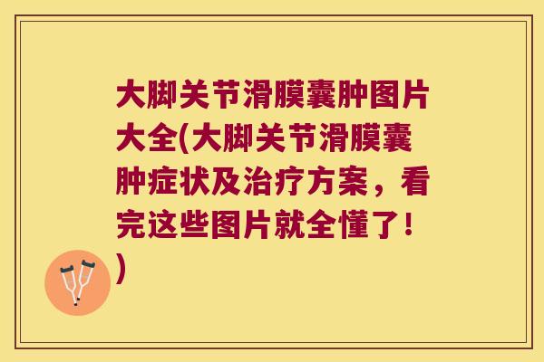 大脚关节滑膜囊肿图片大全(大脚关节滑膜囊肿症状及方案，看完这些图片就全懂了！)