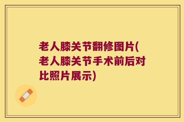老人膝关节翻修图片(老人膝关节手术前后对比照片展示)