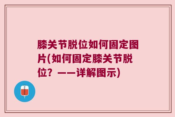 膝关节脱位如何固定图片(如何固定膝关节脱位?——详解图示) 膝关节脱位如何固定图片(如何固定膝关节脱位?——详解图示)
