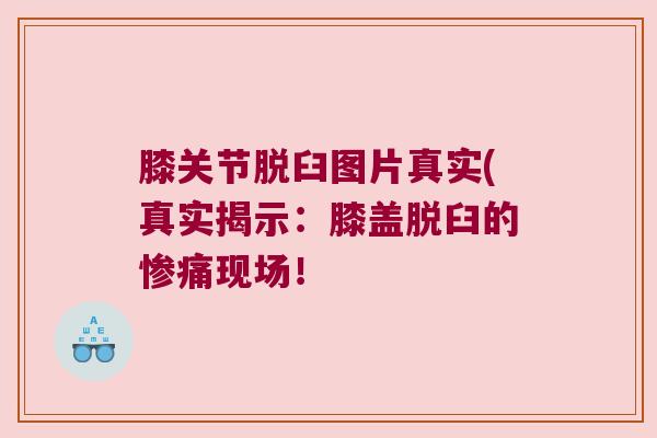 膝关节脱臼图片真实(真实揭示:膝盖脱臼的惨痛现场! 膝关节脱臼图片真实(真实揭示:膝盖脱臼的惨痛现场!